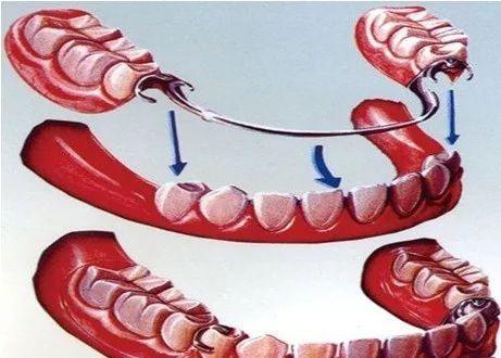 假牙有哪几种类型（科普假牙种类傻傻分不清）(4)