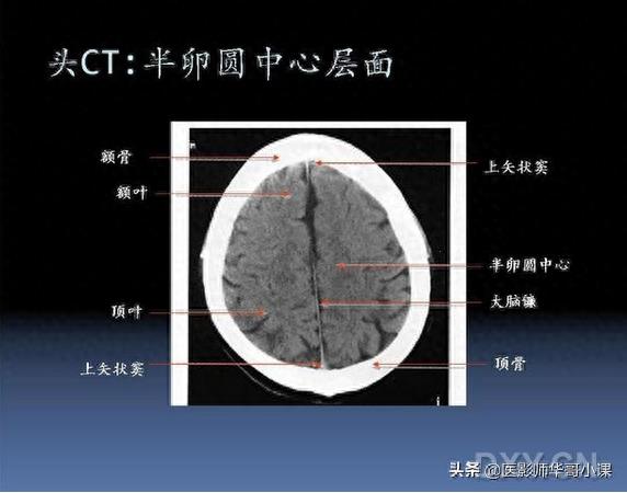 头颅（CT）解剖--精品图集