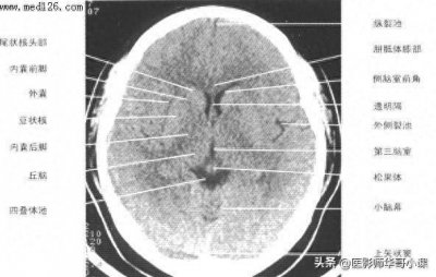 ​头颅（CT）解剖-精品图集