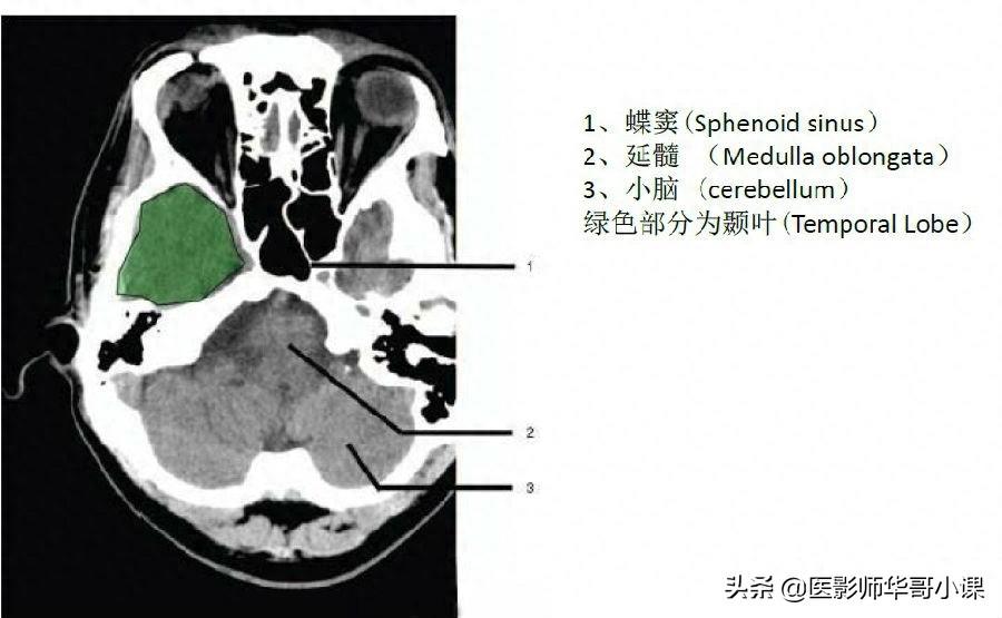 头颅（CT）解剖--精品图集