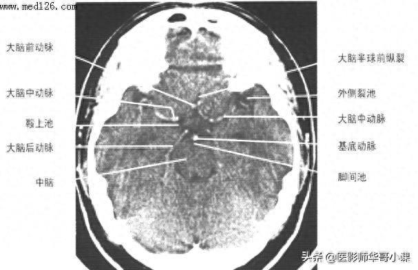 头颅（CT）解剖--精品图集