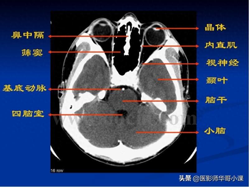 头颅（CT）解剖--精品图集