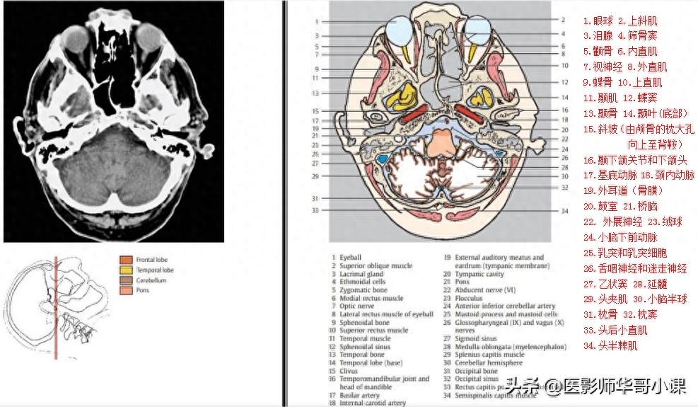 头颅（CT）解剖--精品图集