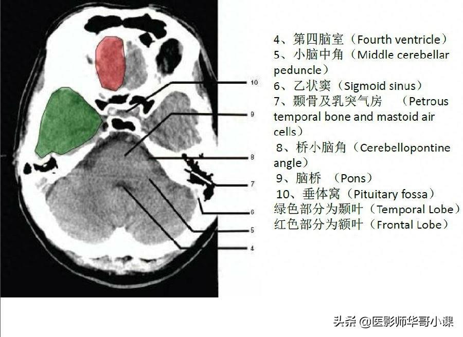 头颅（CT）解剖--精品图集