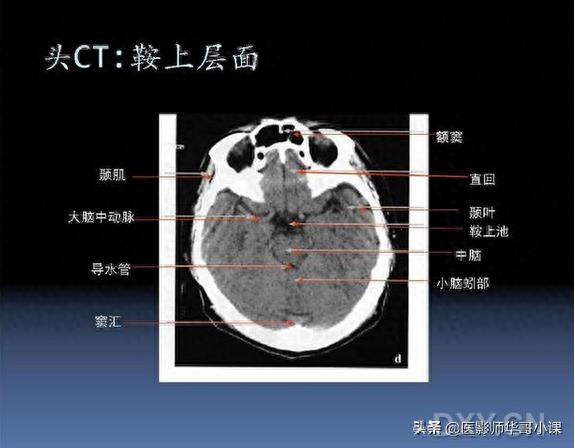 头颅（CT）解剖--精品图集