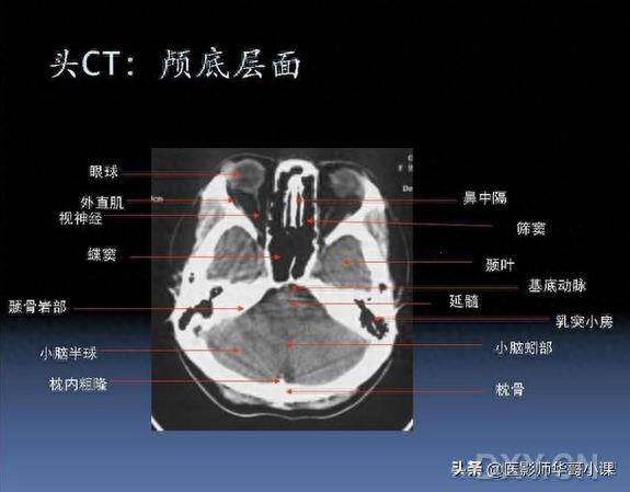 头颅（CT）解剖--精品图集