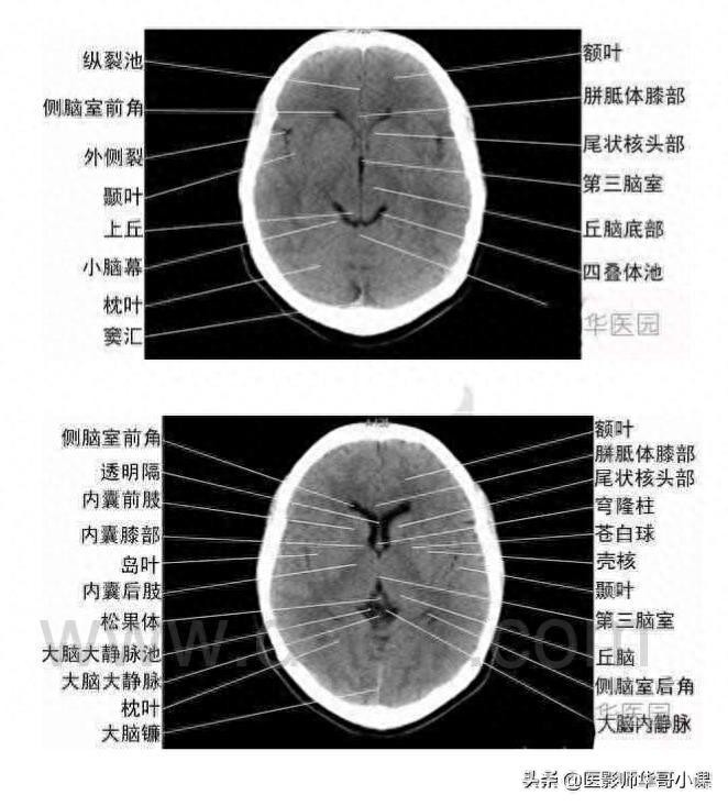 头颅（CT）解剖--精品图集