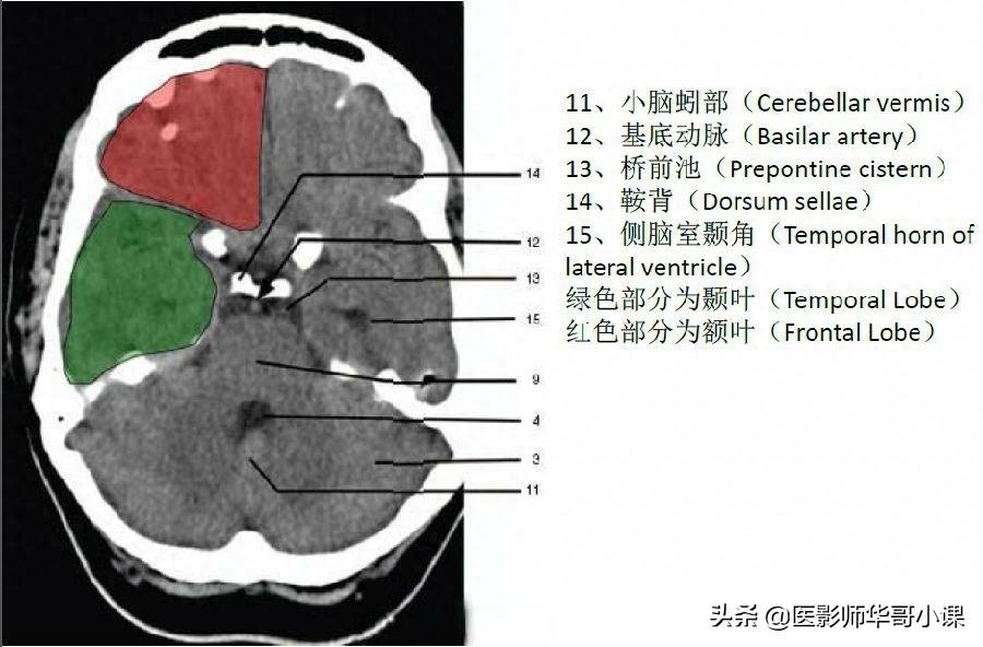 头颅（CT）解剖--精品图集