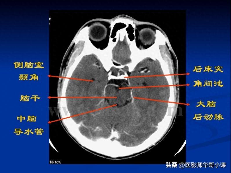 头颅（CT）解剖--精品图集