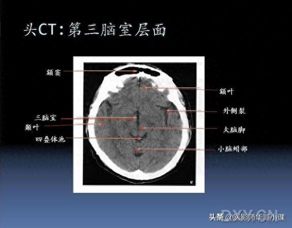 头颅（CT）解剖--精品图集