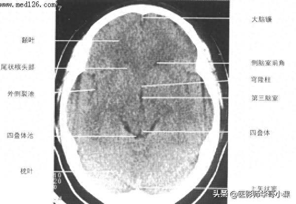 头颅（CT）解剖--精品图集