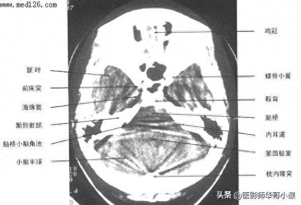 头颅（CT）解剖--精品图集