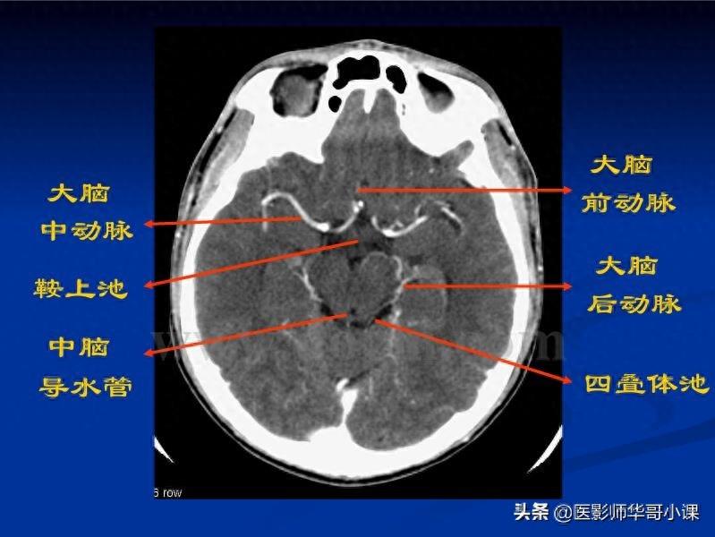 头颅（CT）解剖--精品图集