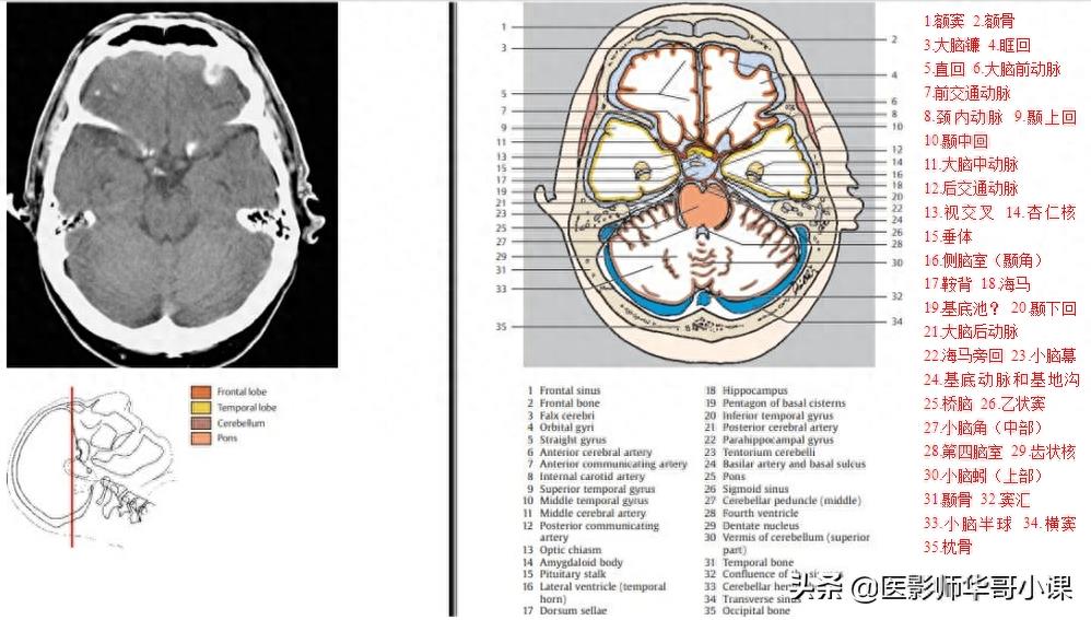 头颅（CT）解剖--精品图集