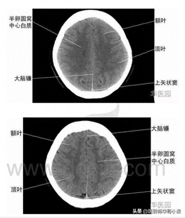 头颅（CT）解剖--精品图集