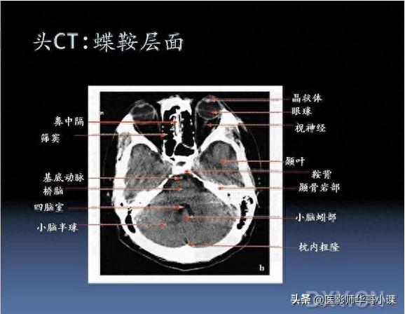 头颅（CT）解剖--精品图集