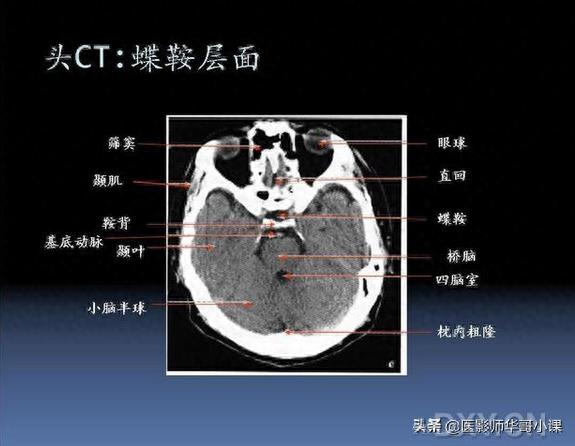 头颅（CT）解剖--精品图集