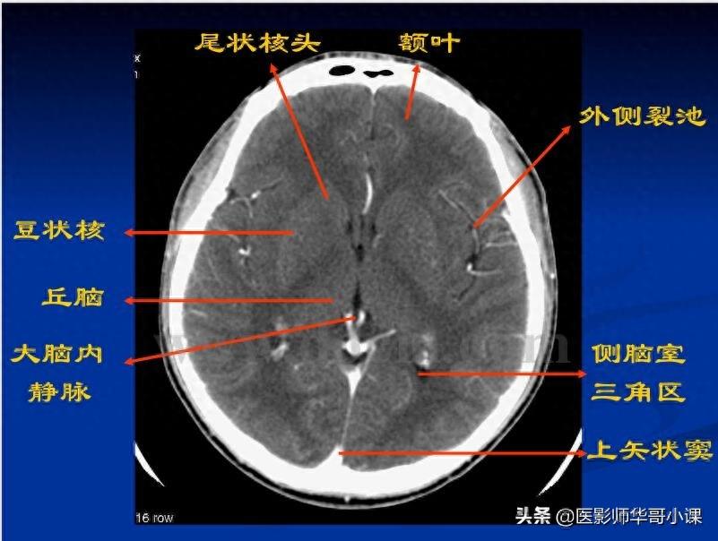 头颅（CT）解剖--精品图集