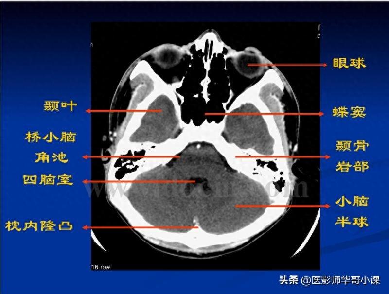 头颅（CT）解剖--精品图集