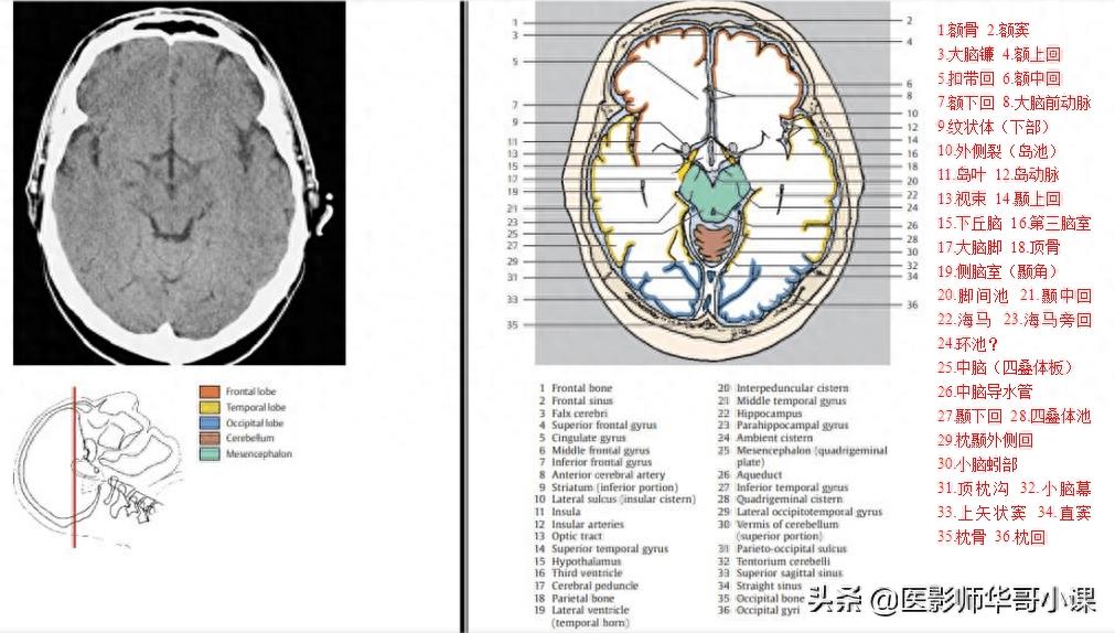 头颅（CT）解剖--精品图集