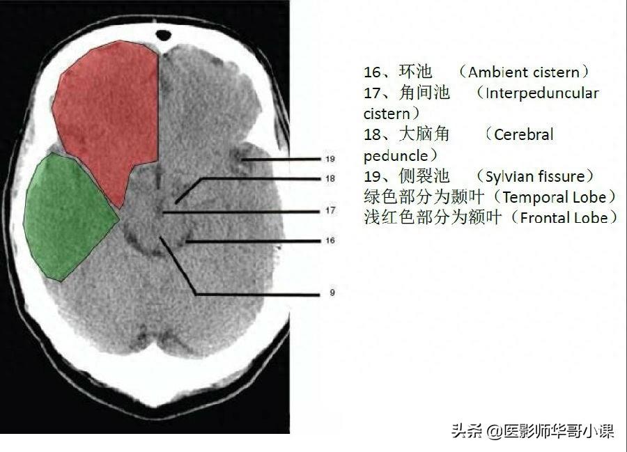 头颅（CT）解剖--精品图集