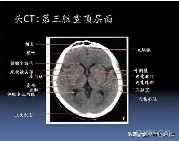 头颅（CT）解剖--精品图集