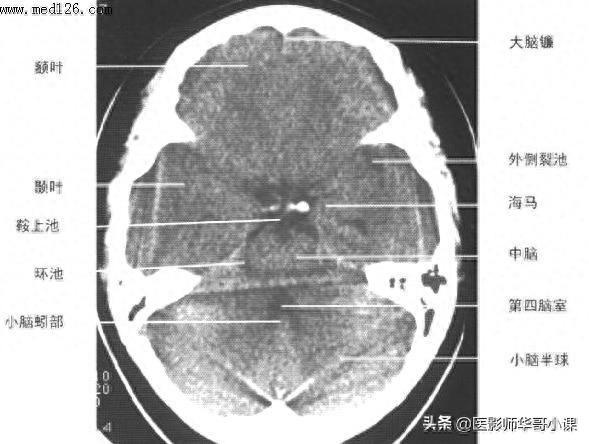 头颅（CT）解剖--精品图集